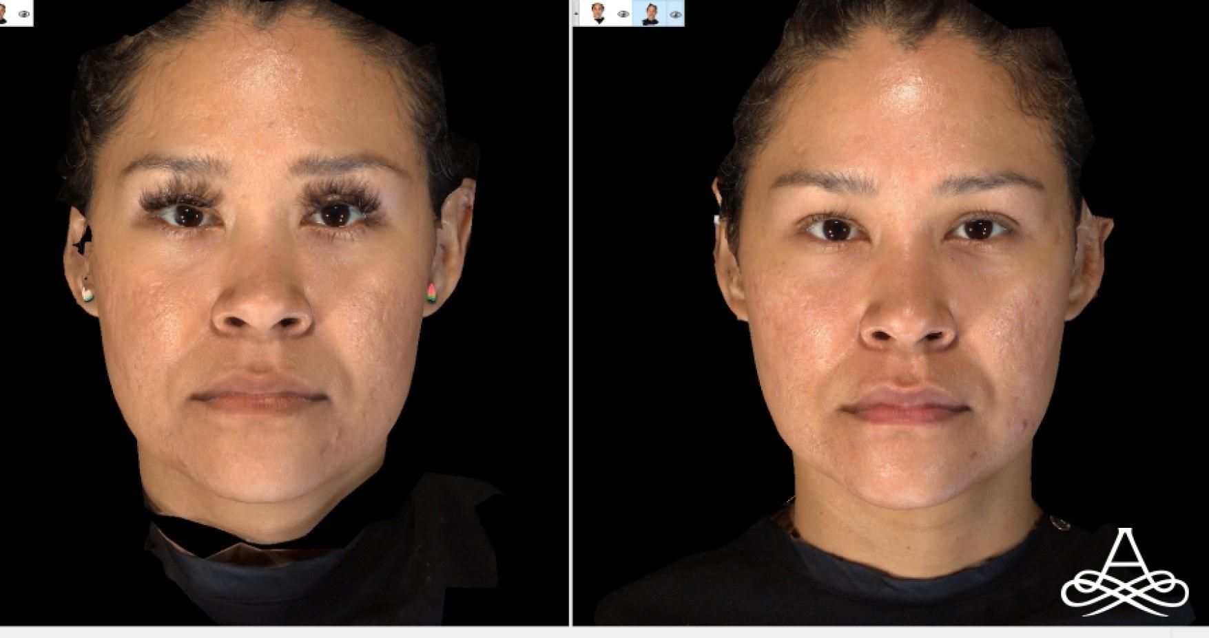 Bellafill®: Patient 5 - Before and After  