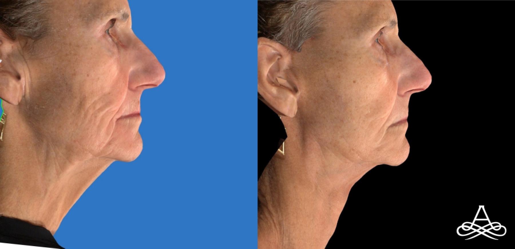Facelift & Neck Lift: Patient 1 - Before and After  