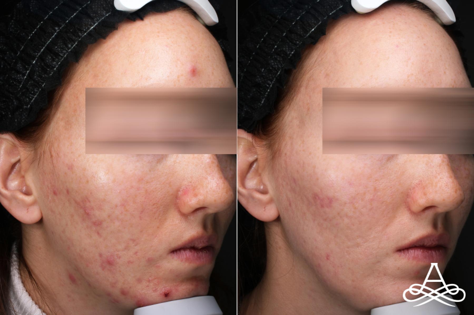 Acne Scars: Patient 8 - Before and After 3