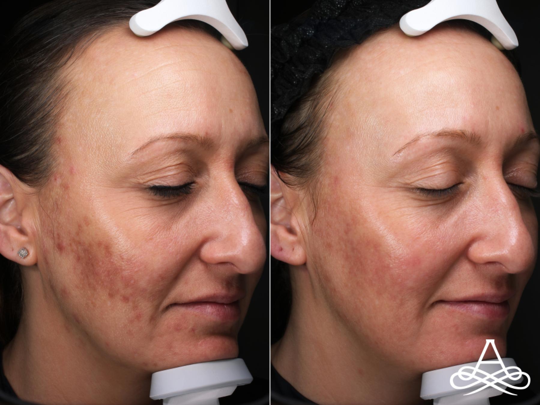 Acne Scars: Patient 1 - Before and After 3