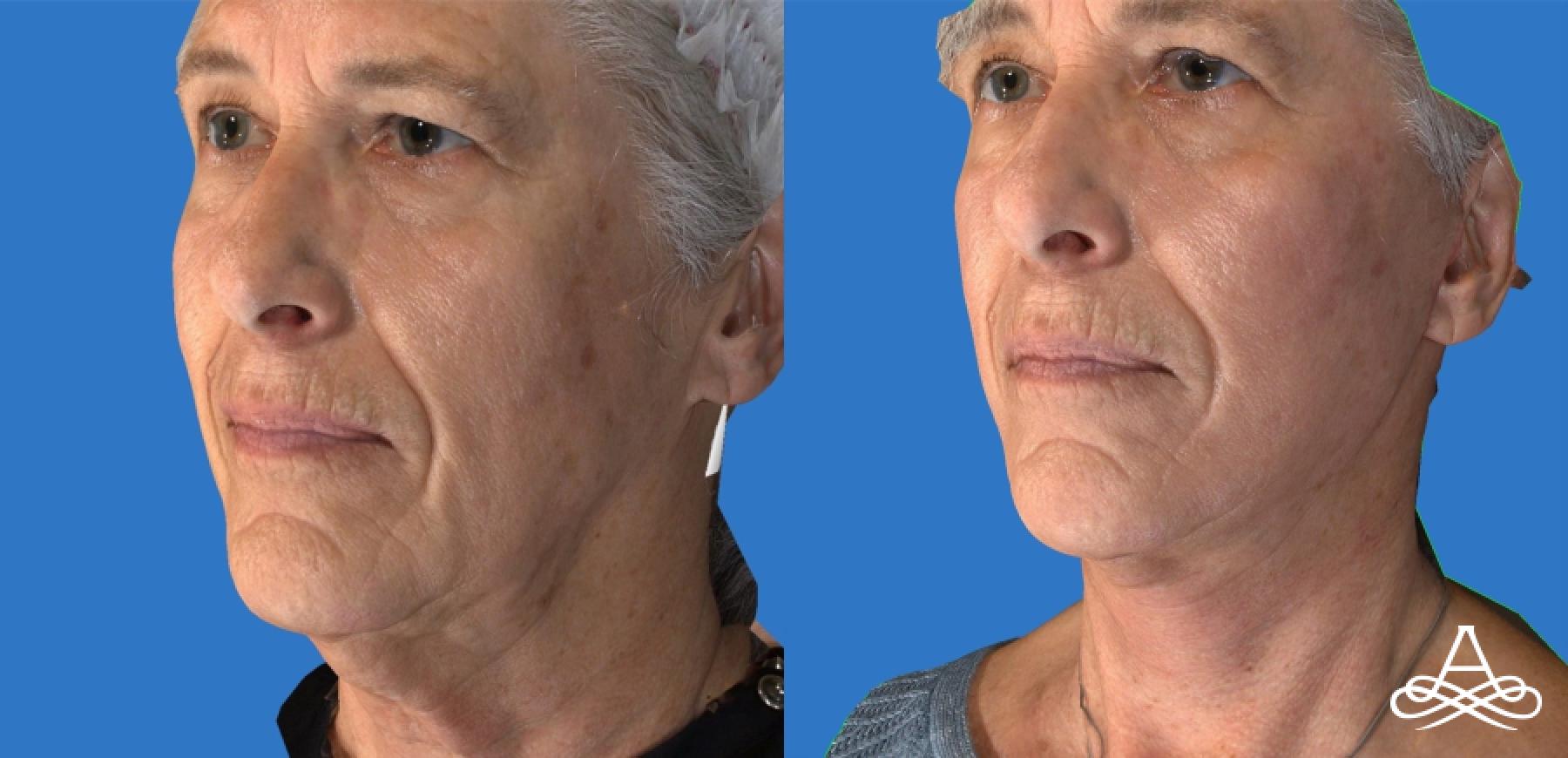 Facelift & Neck Lift: Patient 5 - Before and After  