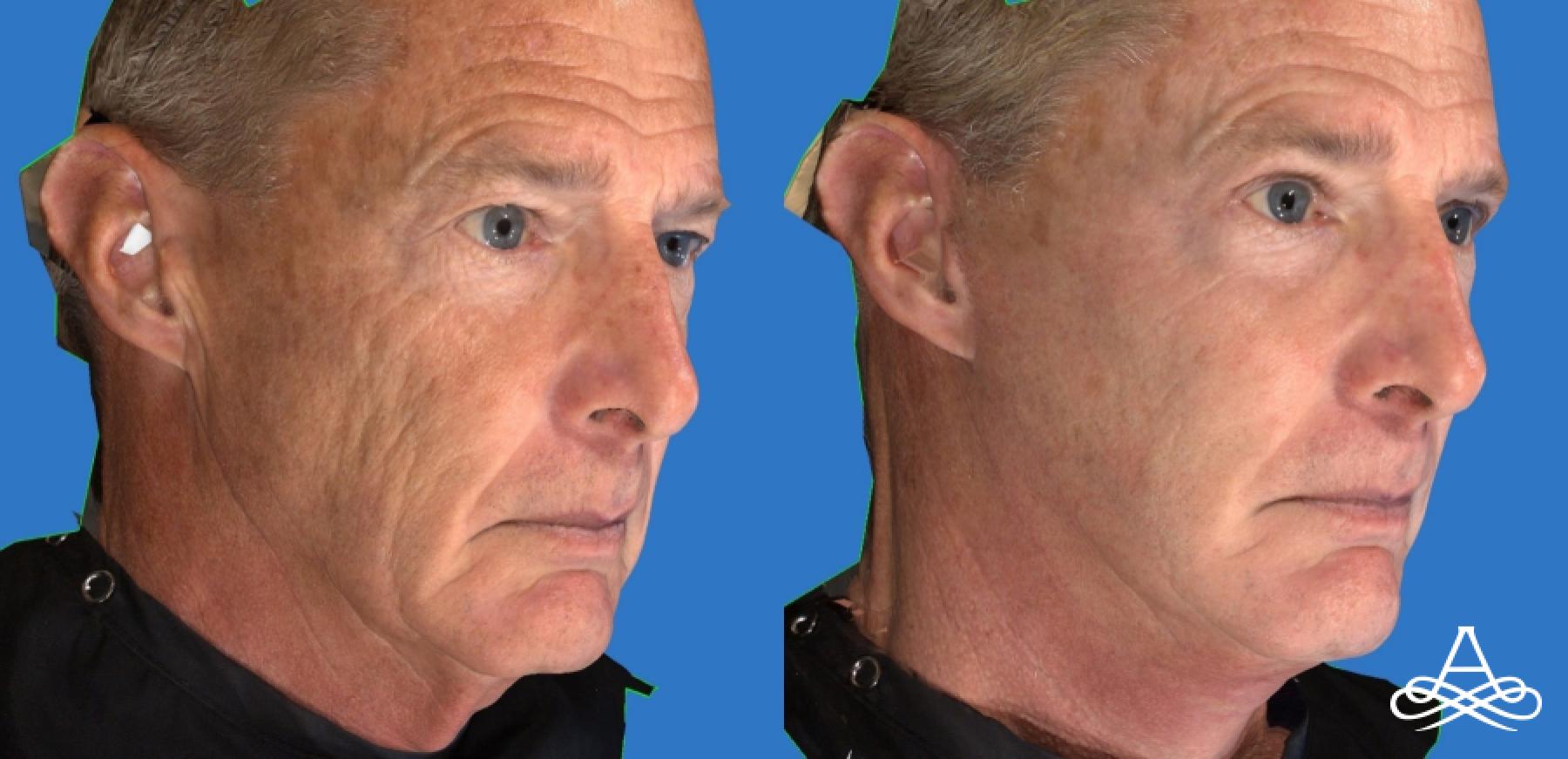 Facelift & Neck Lift: Patient 8 - Before and After  