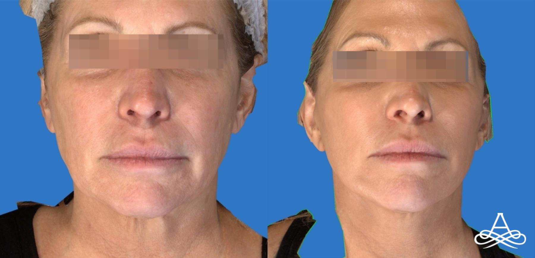 Facelift & Neck Lift: Patient 6 - Before and After  