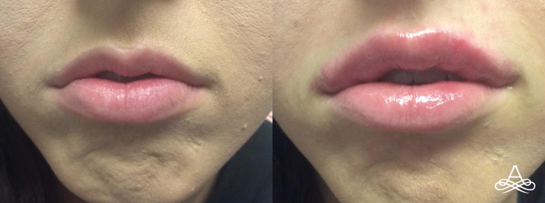 Lip Filler: Patient 5 - Before and After  