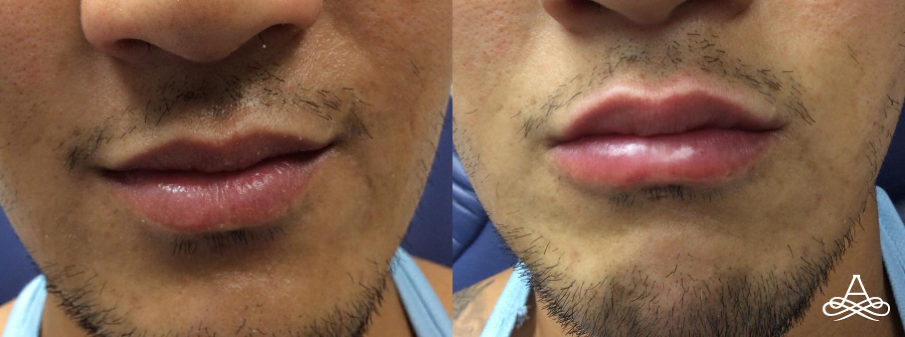 Lip Filler: Patient 4 - Before and After 1