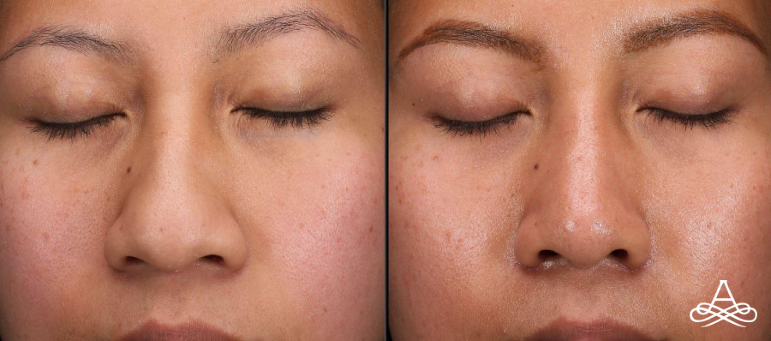Rhinoplasty: Patient 1 - Before and After  