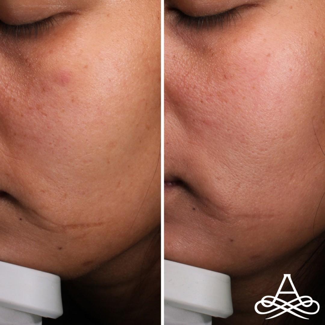 CO2 Laser Resurfacing: Patient 3 - Before and After  