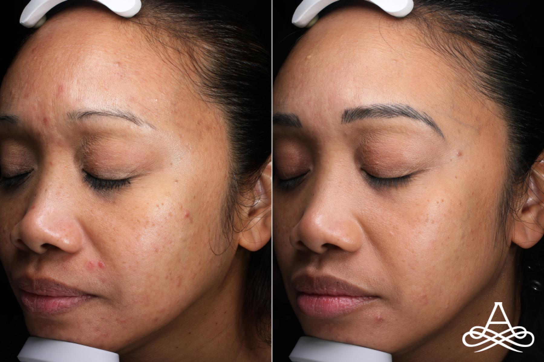 Acne Scars: Patient 2 - Before and After 2