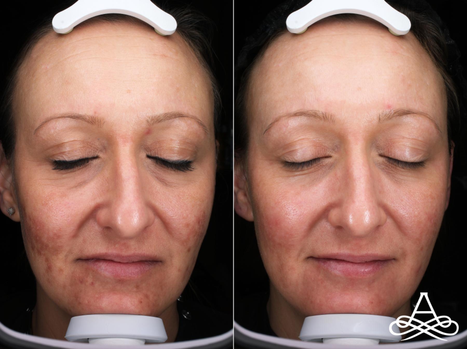 Acne Scars: Patient 1 - Before and After  