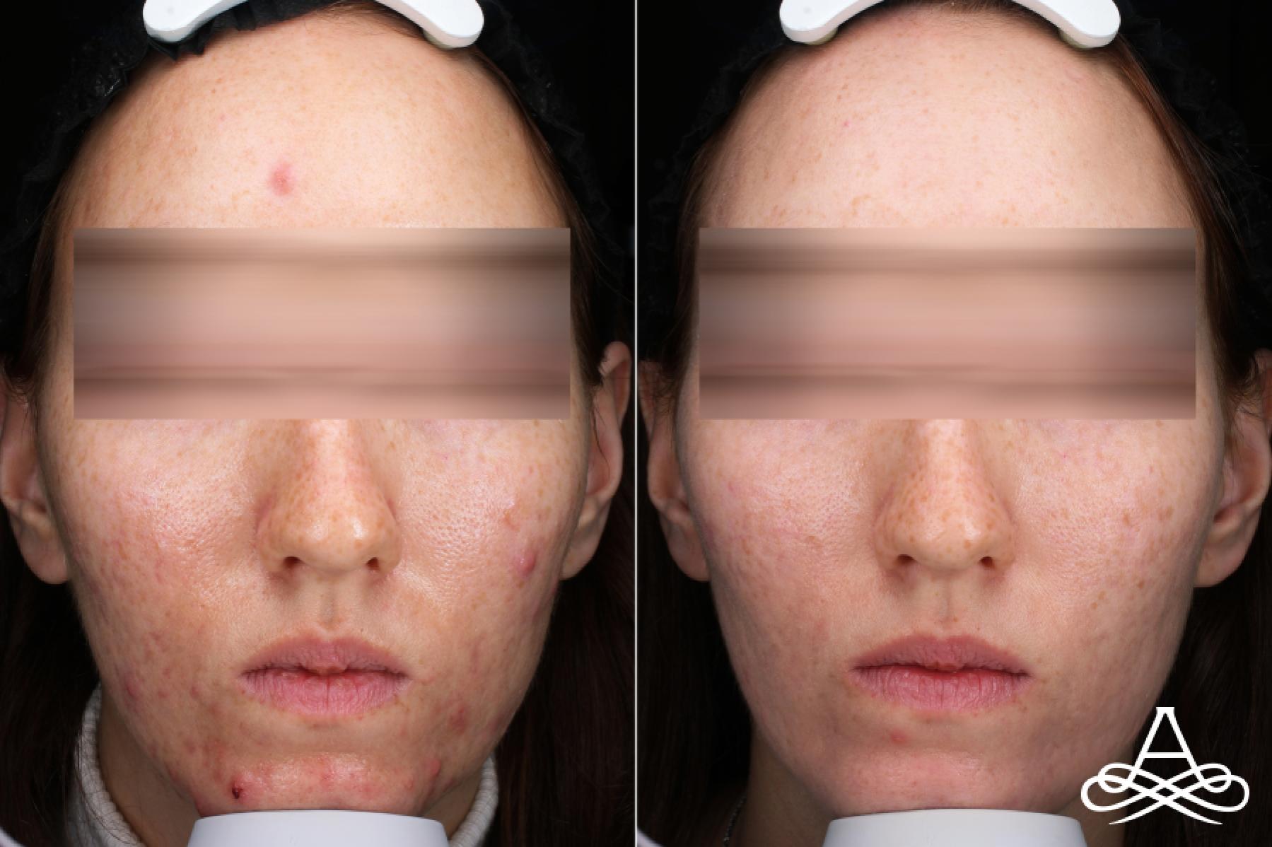 Acne Scars: Patient 8 - Before and After 1