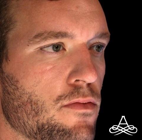 Scar Revision: Patient 1 - Before 