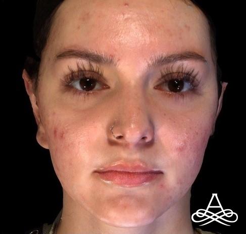 Otoplasty: Patient 2 - After  