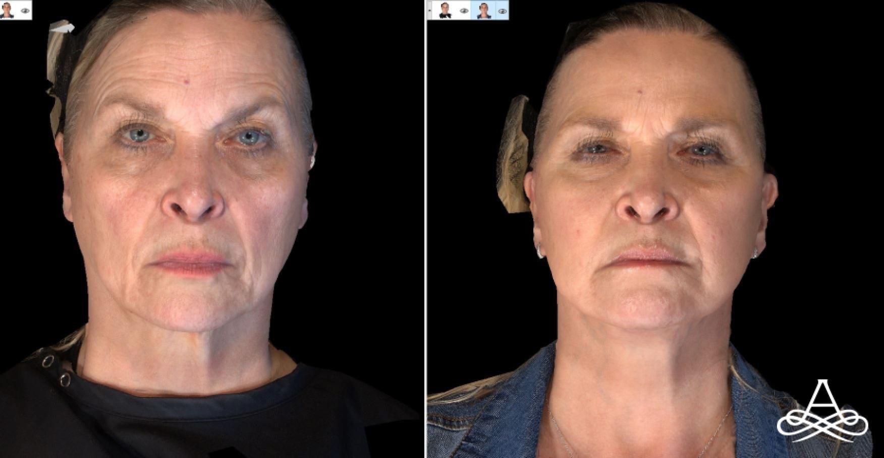 Bellafill®: Patient 6 - Before and After 1