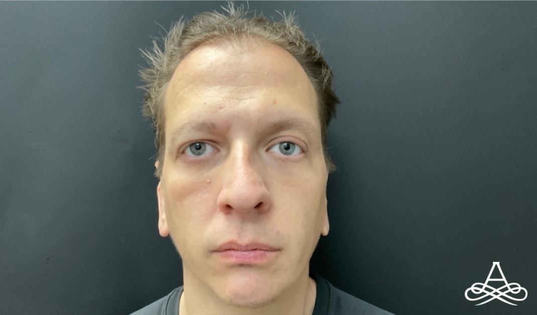 Otoplasty: Patient 1 - After  