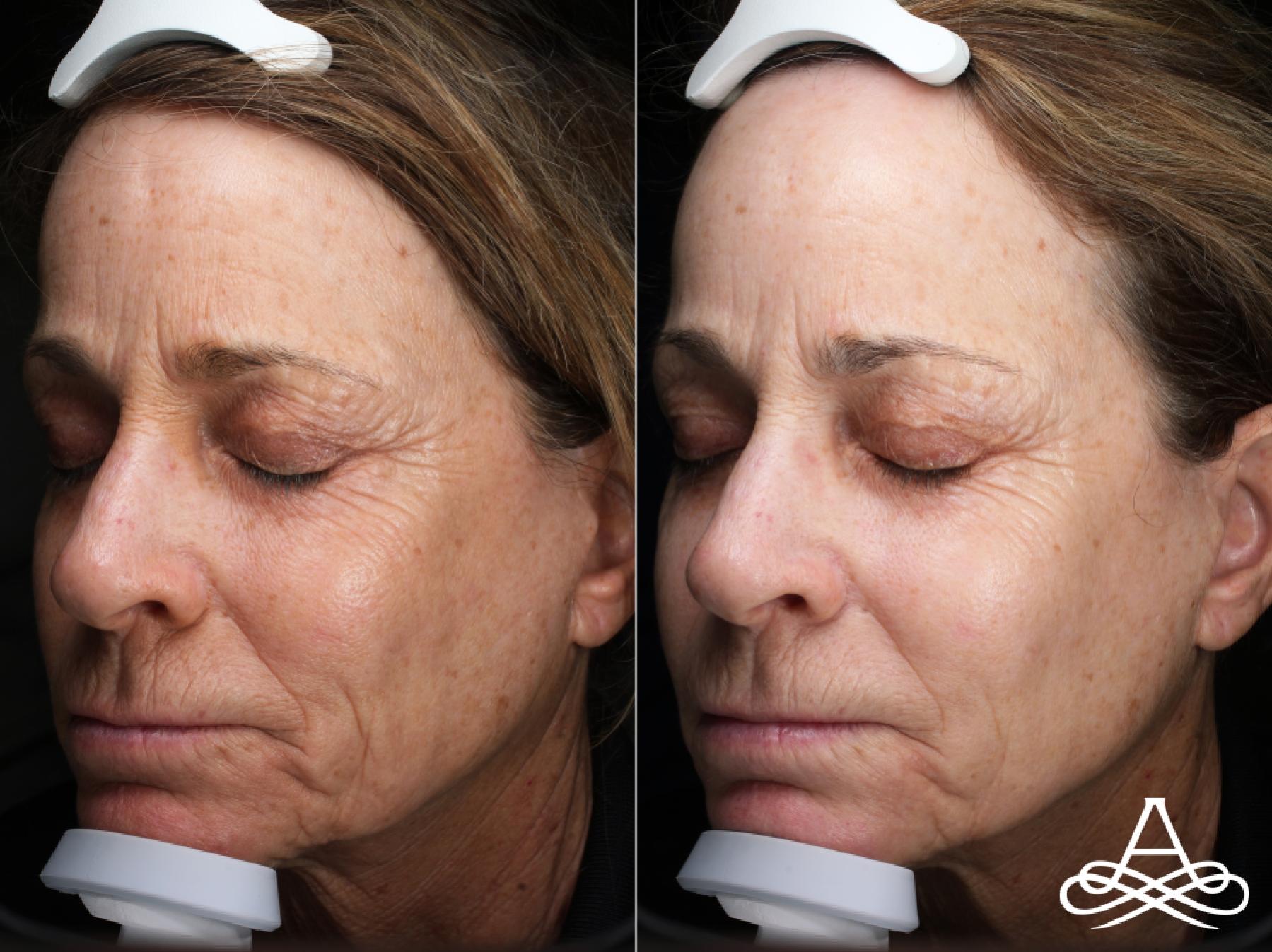 CO2 Laser Resurfacing: Patient 6 - Before and After  