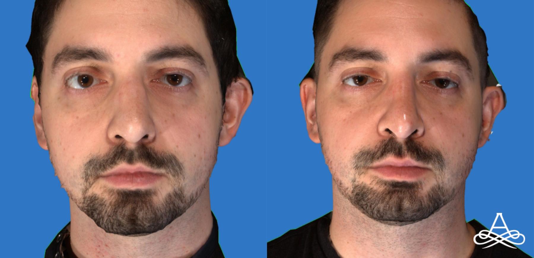 Rhinoplasty: Patient 9 - Before and After  