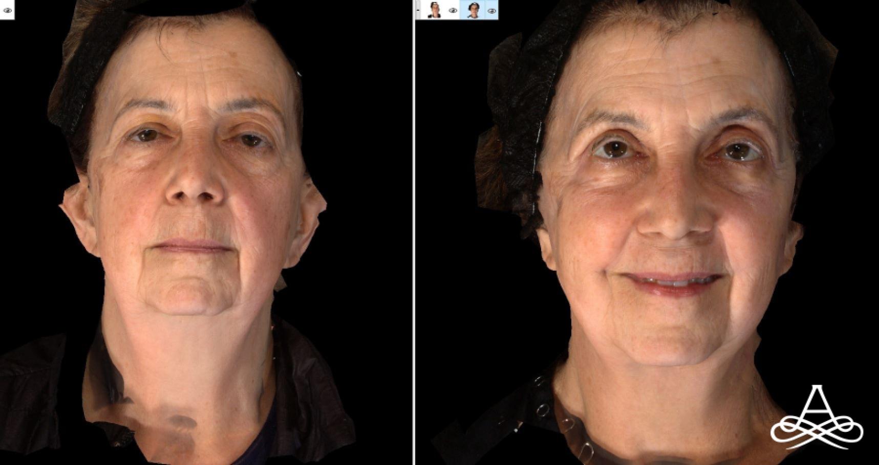 Bellafill®: Patient 7 - Before and After 1