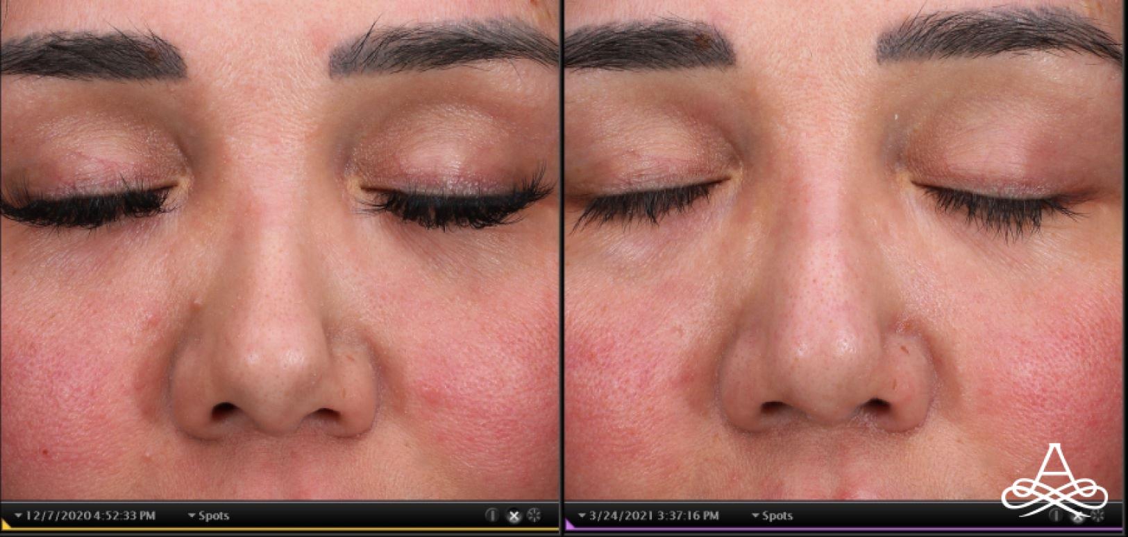 Rhinoplasty: Patient 8 - Before and After  