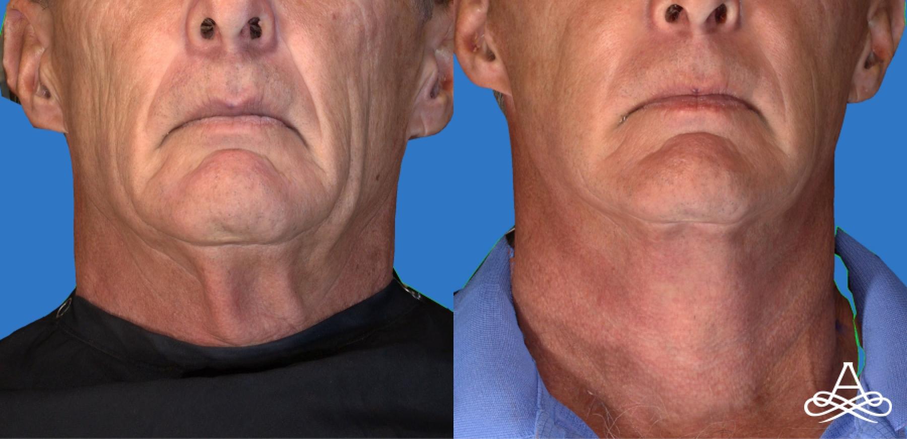 Facelift: Patient 4 - Before 