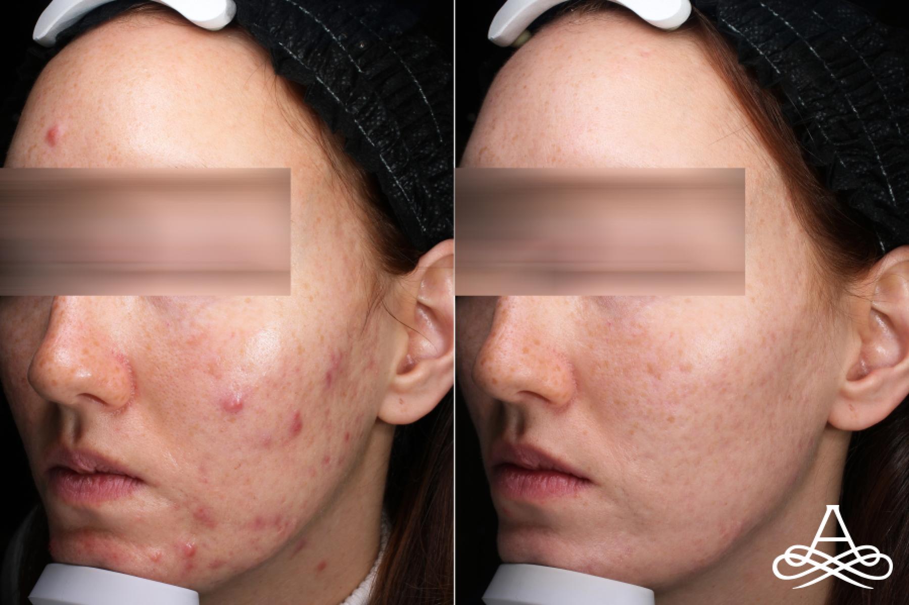 Acne Scars: Patient 8 - Before and After 2