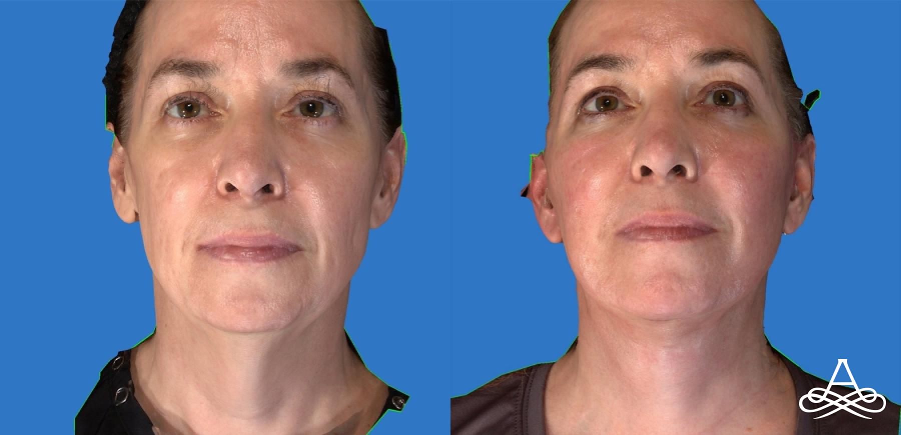 Facelift & Neck Lift: Patient 4 - Before and After  