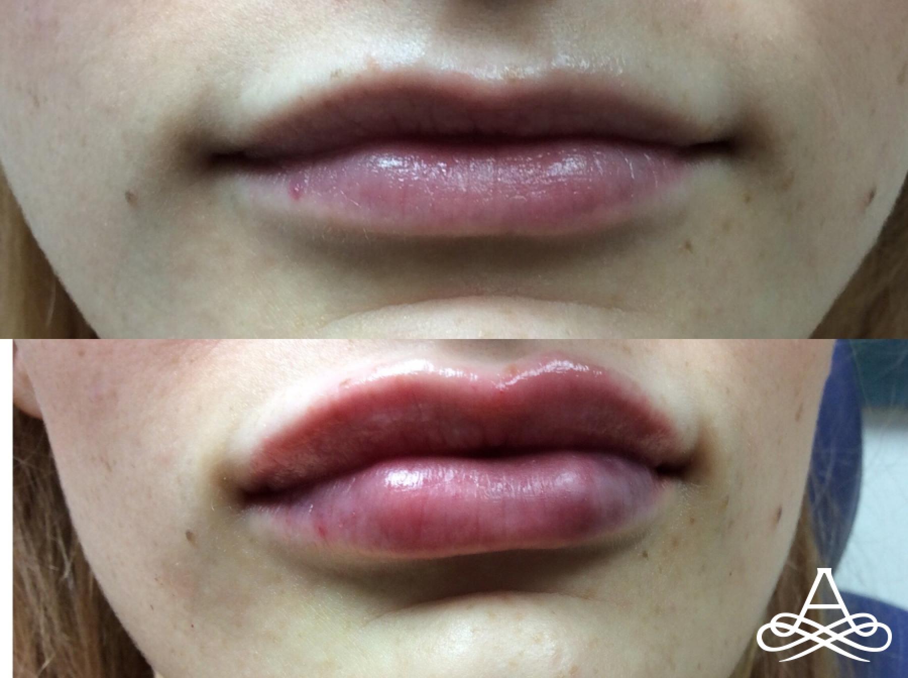 Lip Filler: Patient 7 - Before and After 1