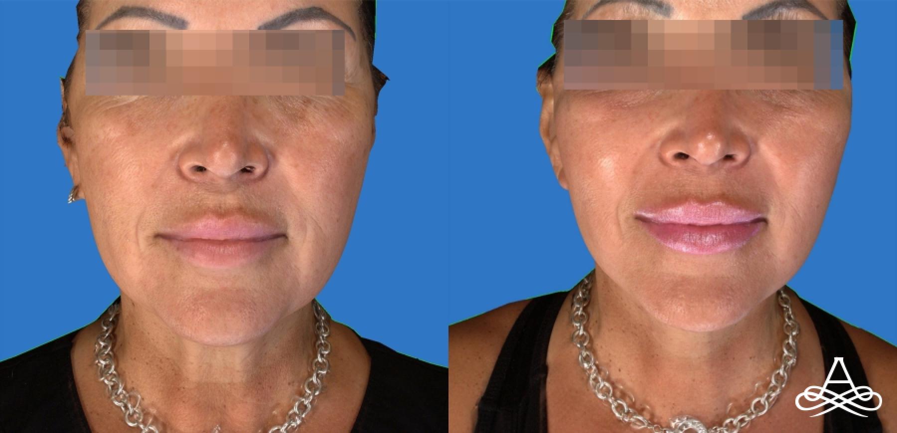 Facelift & Neck Lift: Patient 9 - Before and After  