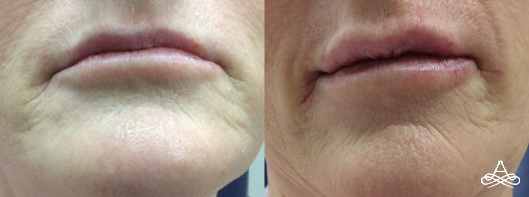 Lip Filler: Patient 10 - Before and After  