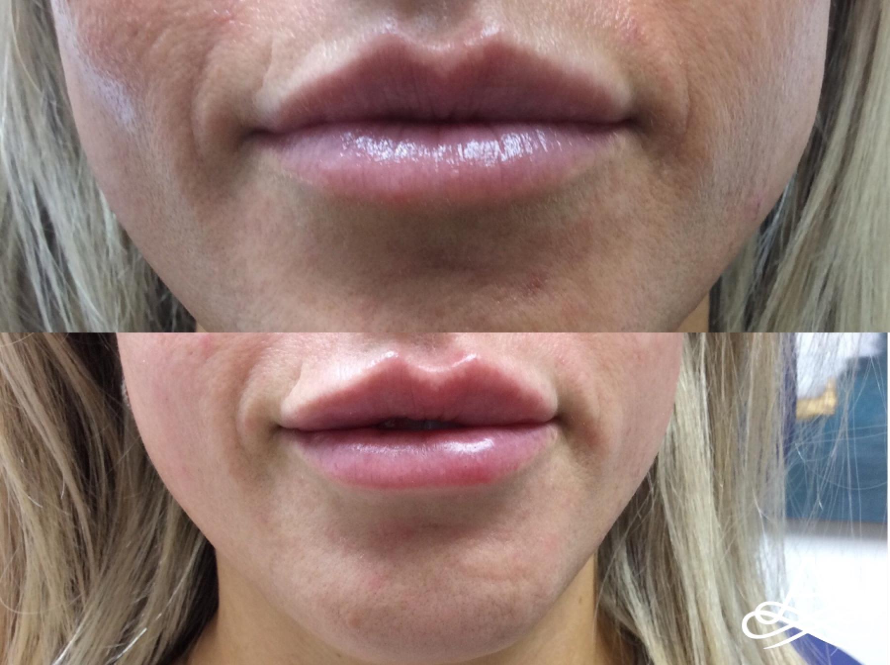 Lip Filler: Patient 3 - Before and After 1