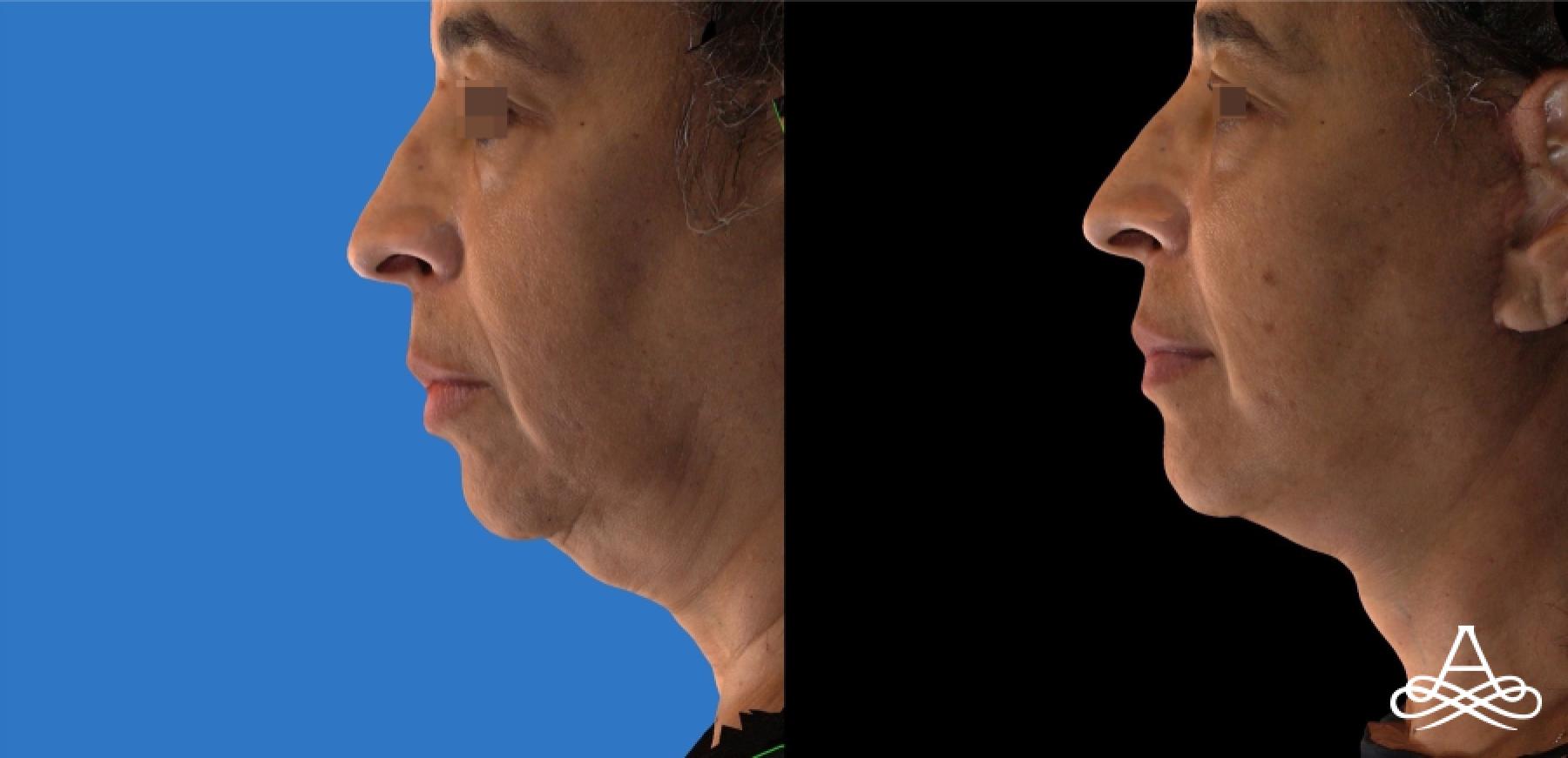 Facelift & Neck Lift: Patient 3 - Before and After  