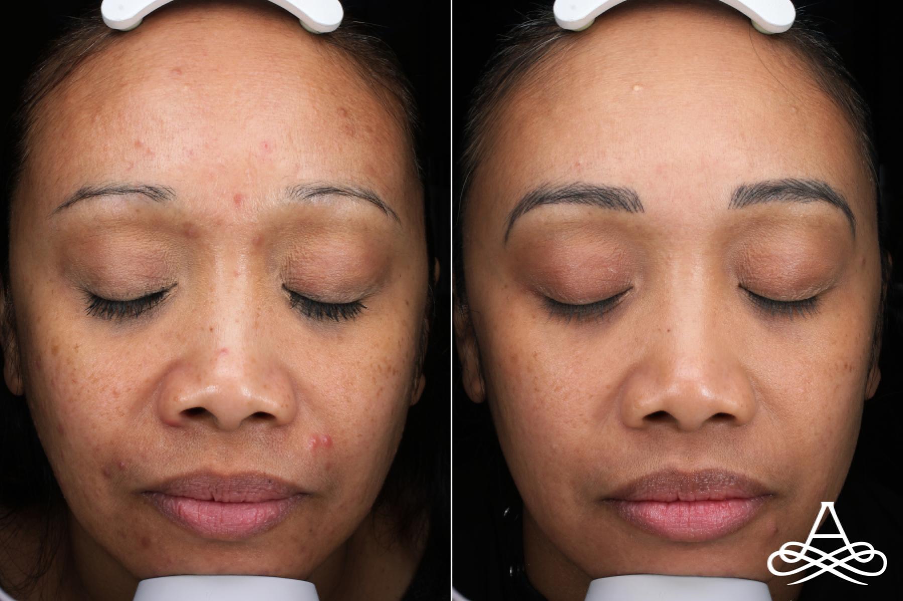 Acne Scars: Patient 2 - Before and After  