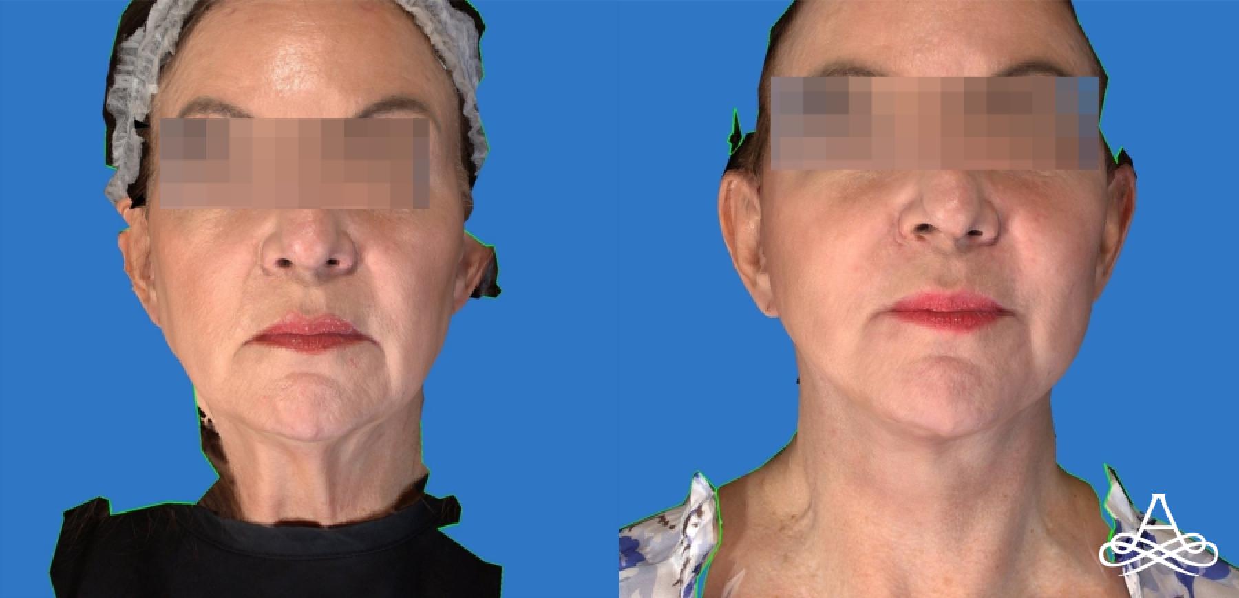 Facelift & Neck Lift: Patient 10 - Before and After  