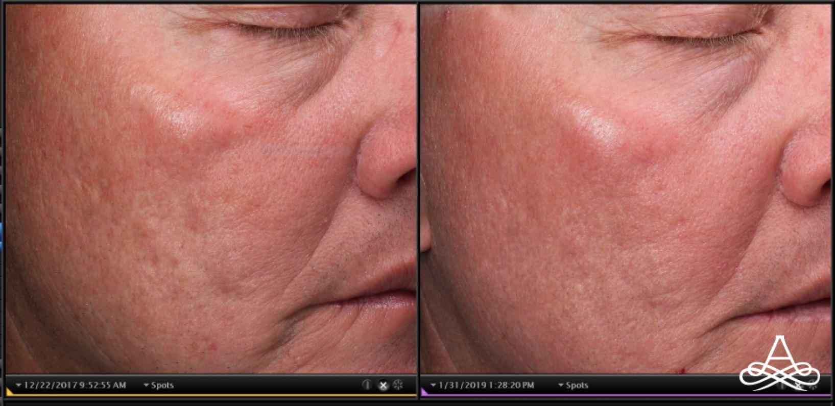 Acne Scars: Patient 5 - Before and After 1