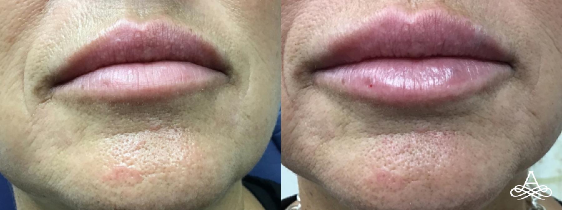 Lip Filler: Patient 6 - Before and After 1