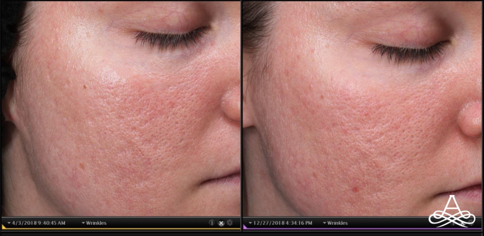 Acne Scars: Patient 3 - Before and After  