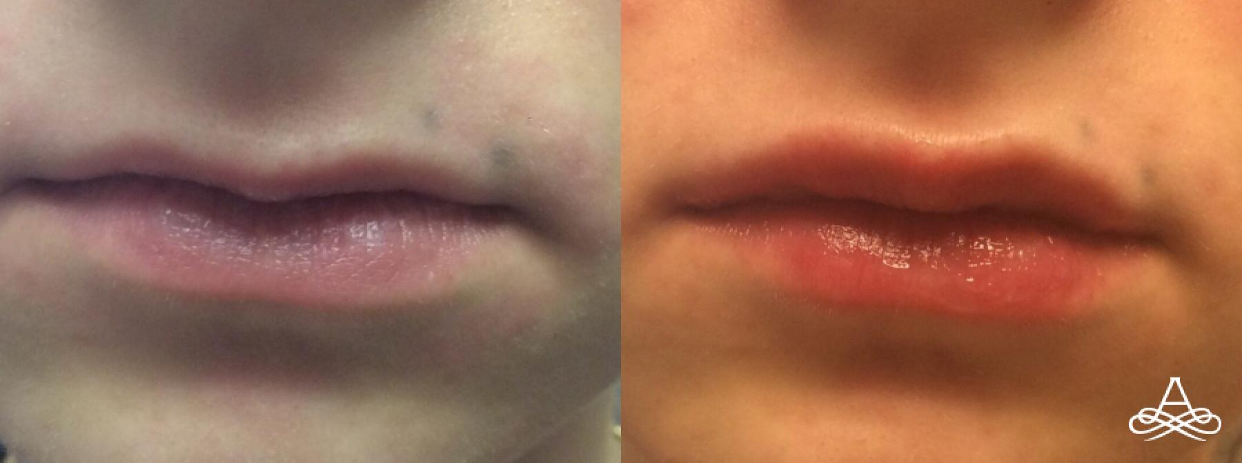 Lip Filler: Patient 8 - Before and After 1
