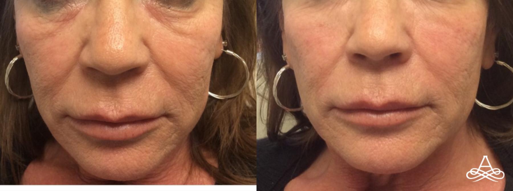 Bellafill®: Patient 2 - Before and After  