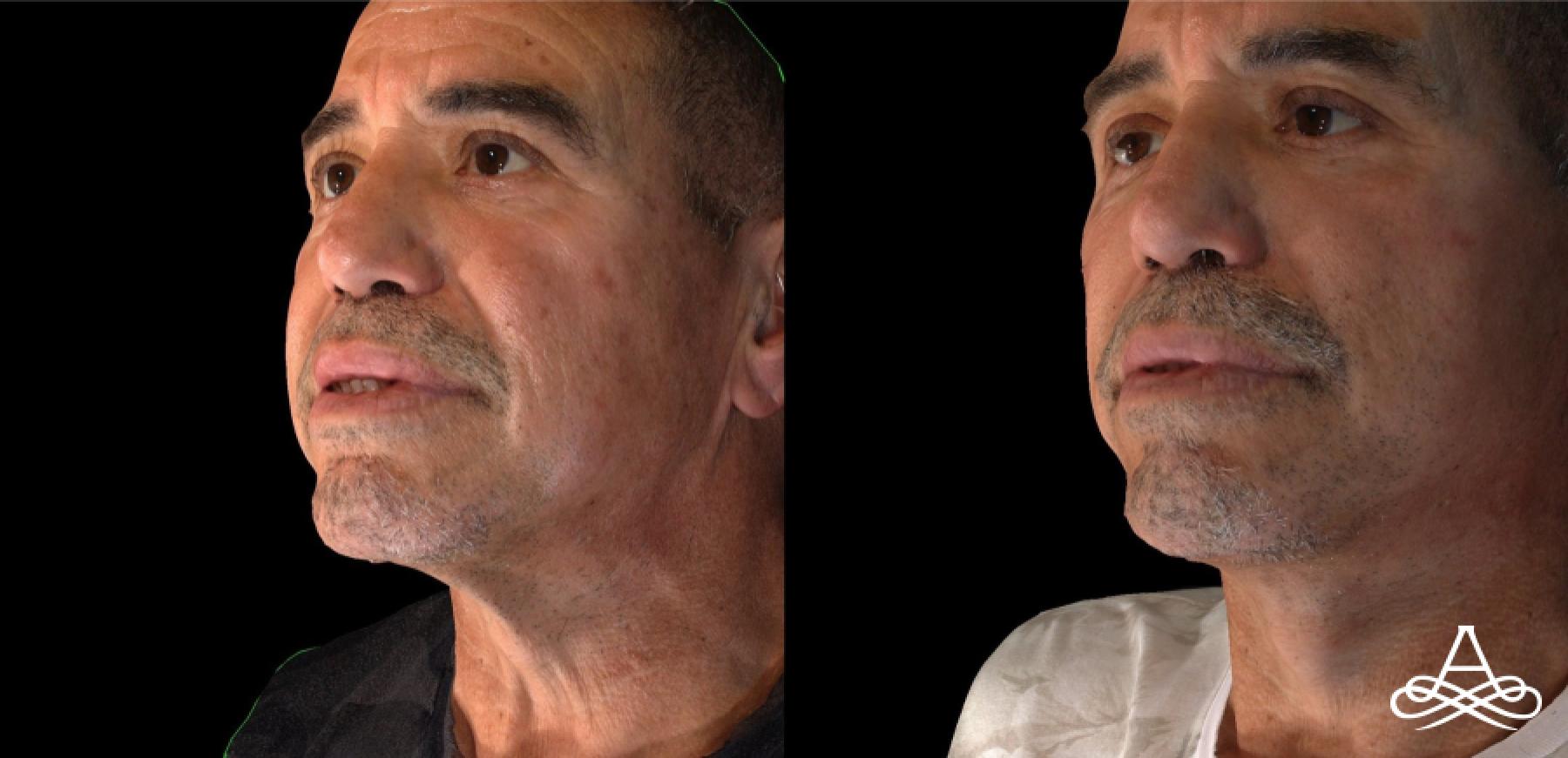 Facelift & Neck Lift: Patient 7 - Before and After  