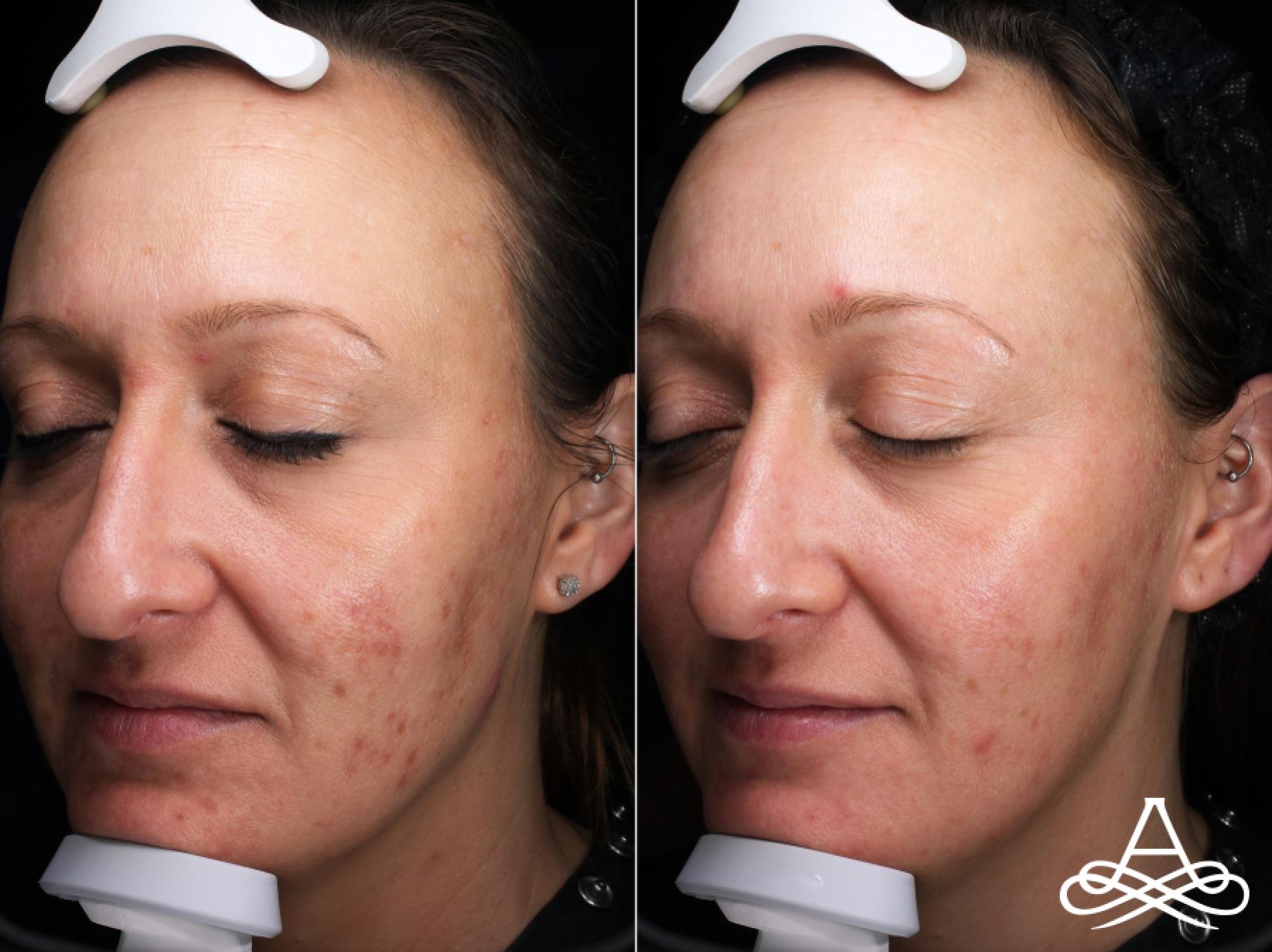 Acne Scars: Patient 1 - Before and After 2