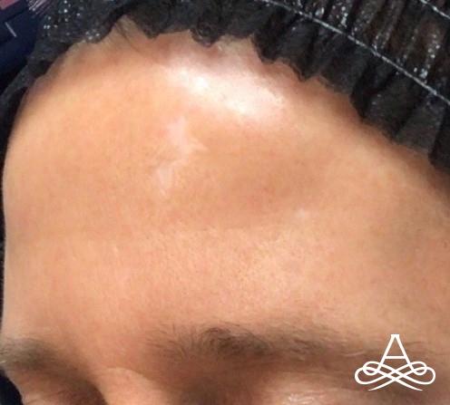 CO2 Laser Resurfacing: Patient 1 - After  
