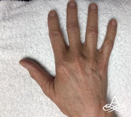 Hand Rejuvenation: Patient 1 - After  
