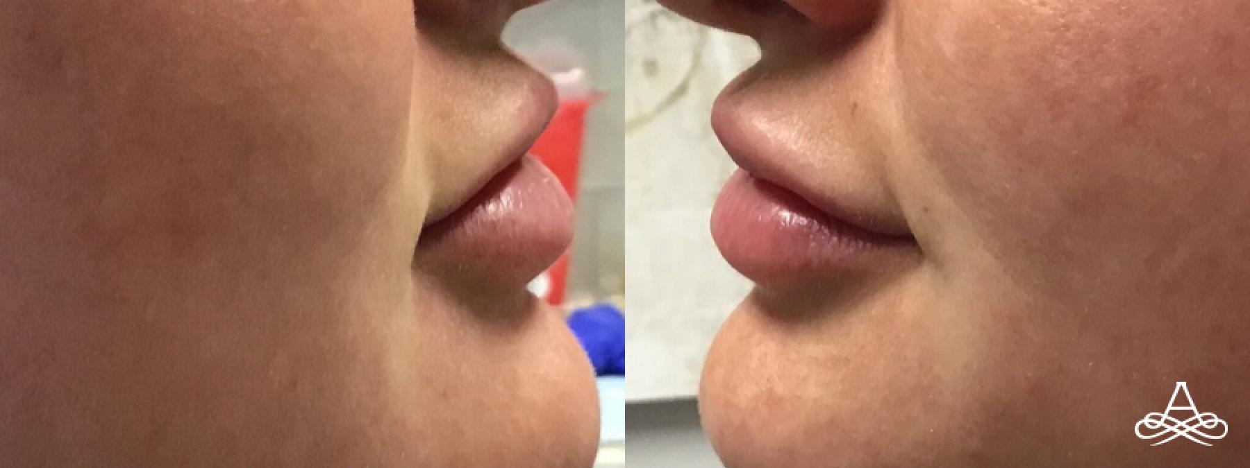 Lip Filler: Patient 9 - Before and After 1
