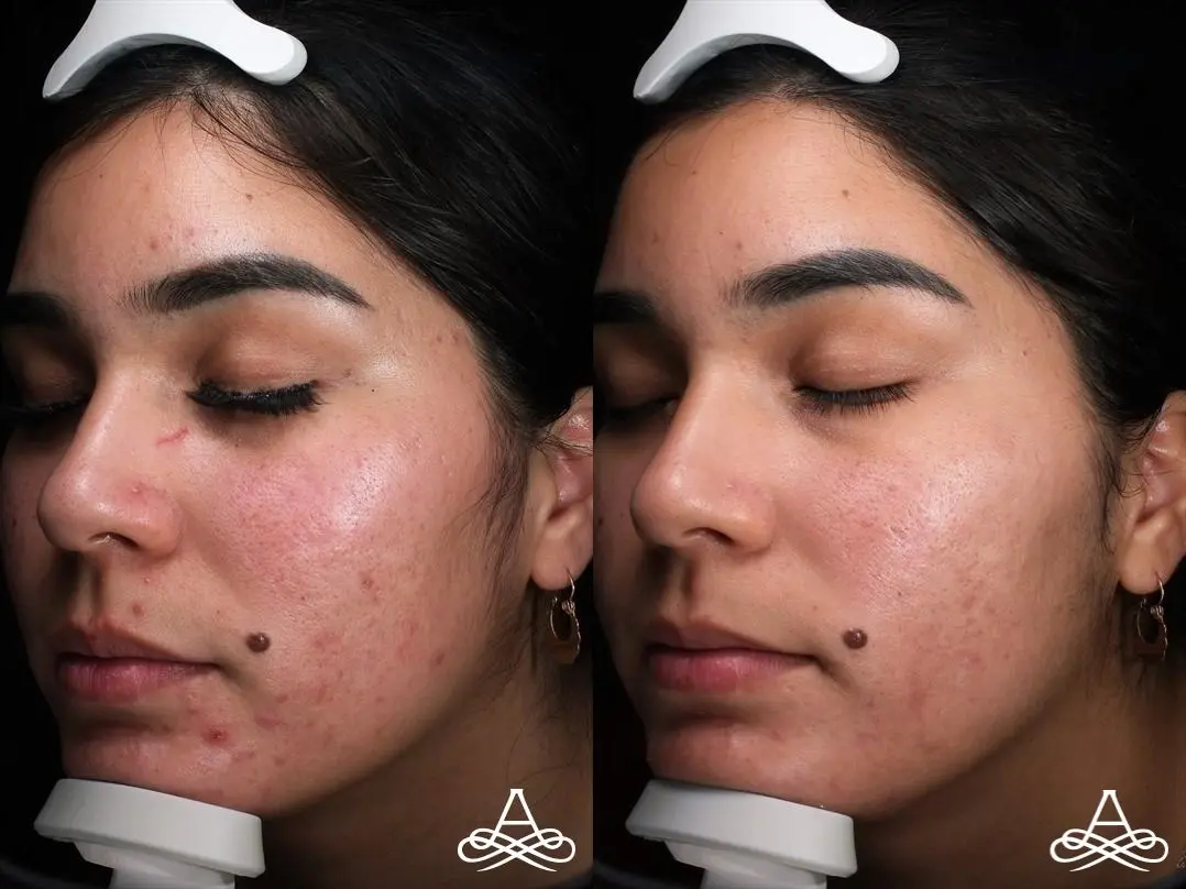 Acne Scars: Patient 9 - Before and After  