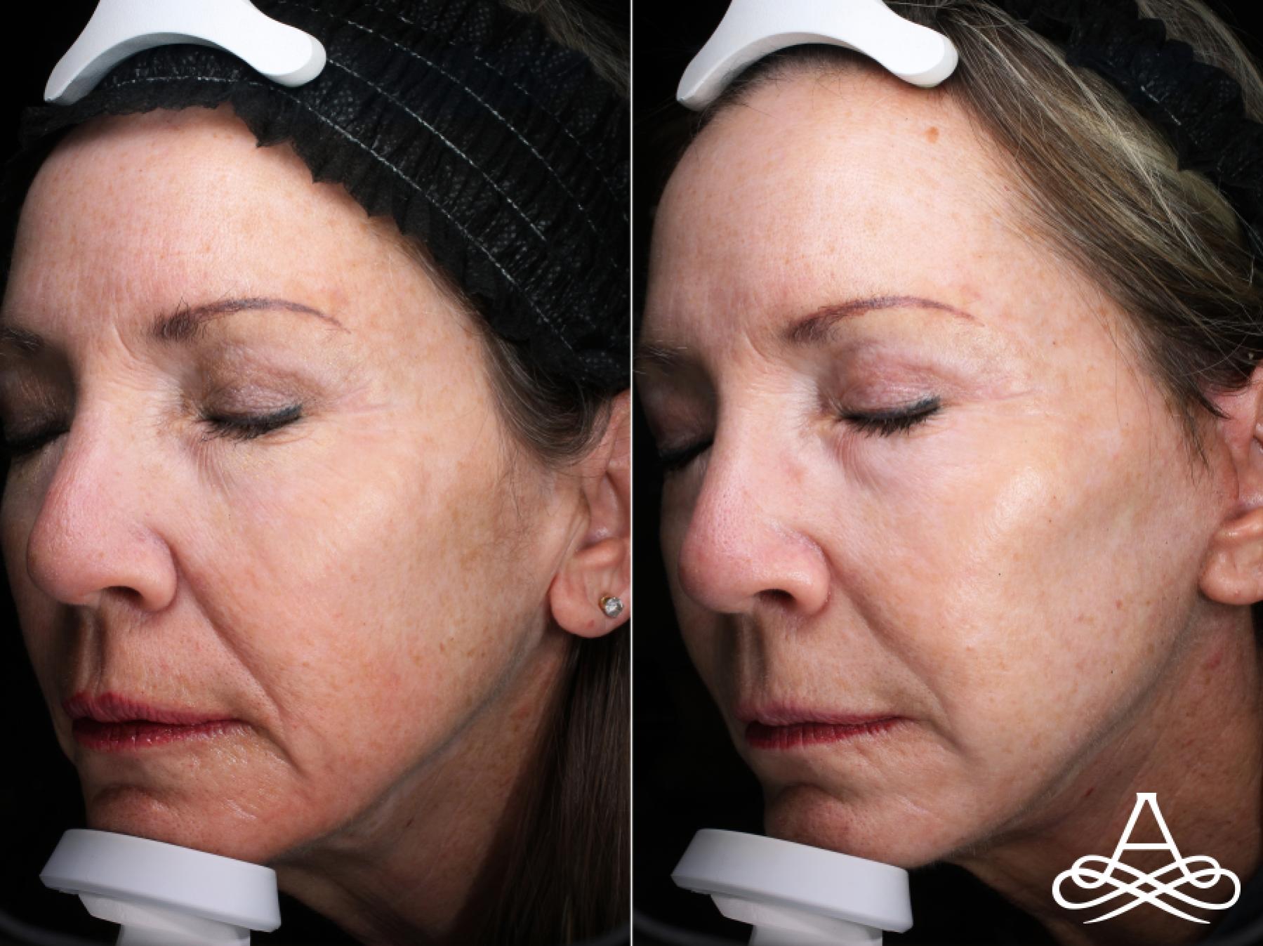 CO2 Laser Resurfacing: Patient 3 - Before and After  
