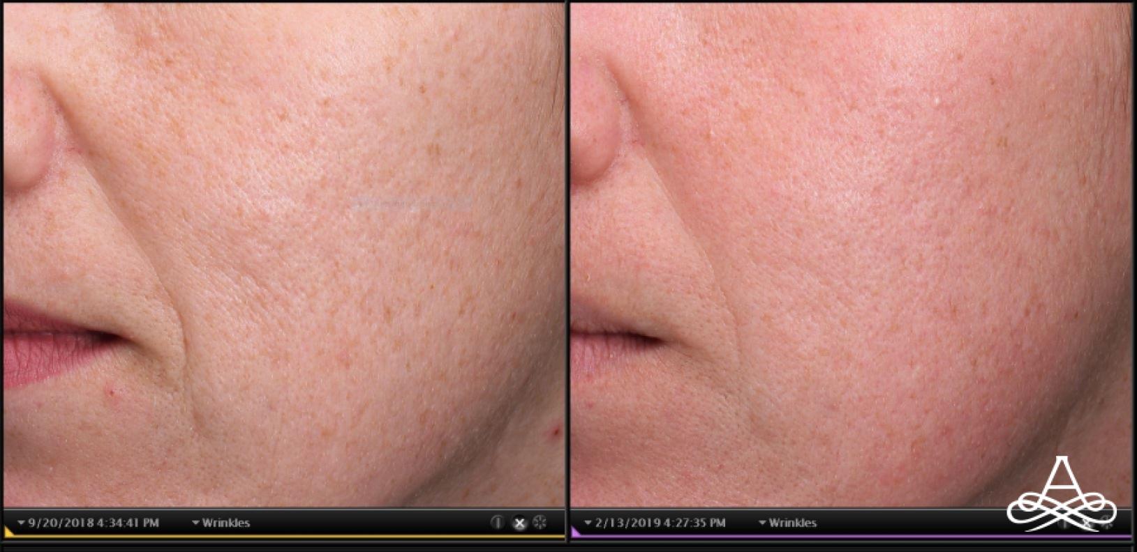 Acne Scars: Patient 6 - Before and After  
