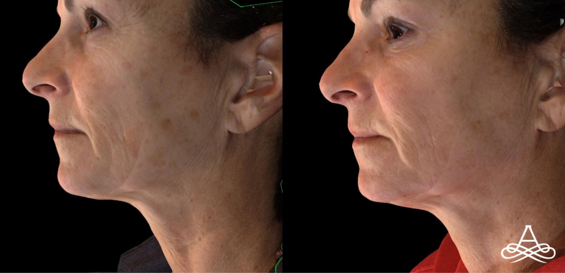 CO2 Laser Resurfacing: Patient 2 - Before and After  