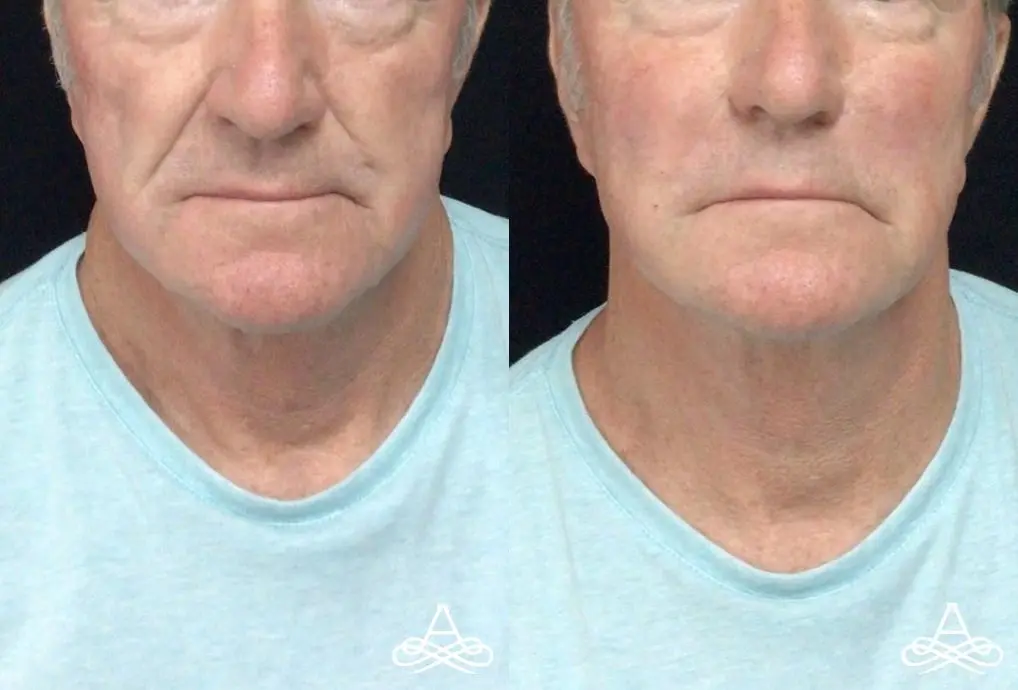 Fillers: Patient 1 - Before and After  