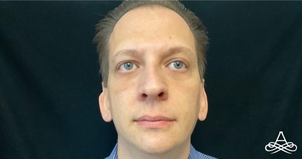 Otoplasty: Patient 1 - Before 