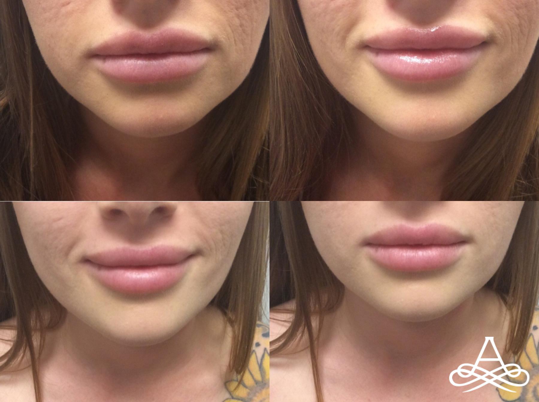 Lip Filler: Patient 2 - Before and After 1
