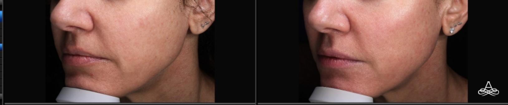 CO2 Laser Resurfacing: Patient 7 - Before and After  